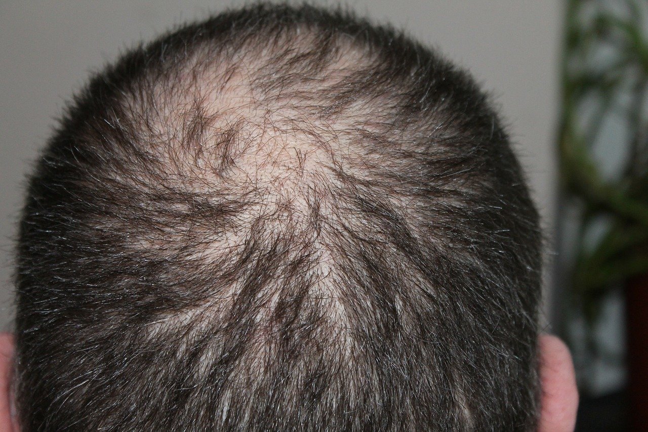 man thinning head